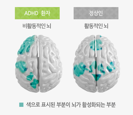 adhd환자 : 비활동적인 뇌, 정상인 : 활동적인 뇌 , 파란색으로 표시된 부분이 뇌가 활성화된 부분