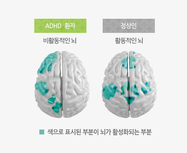 adhd 환자: 비활동적인 뇌, 정상인 : 활동적인 뇌 , 파란색으로 표시된 부분이 뇌가 활성화되는 부분