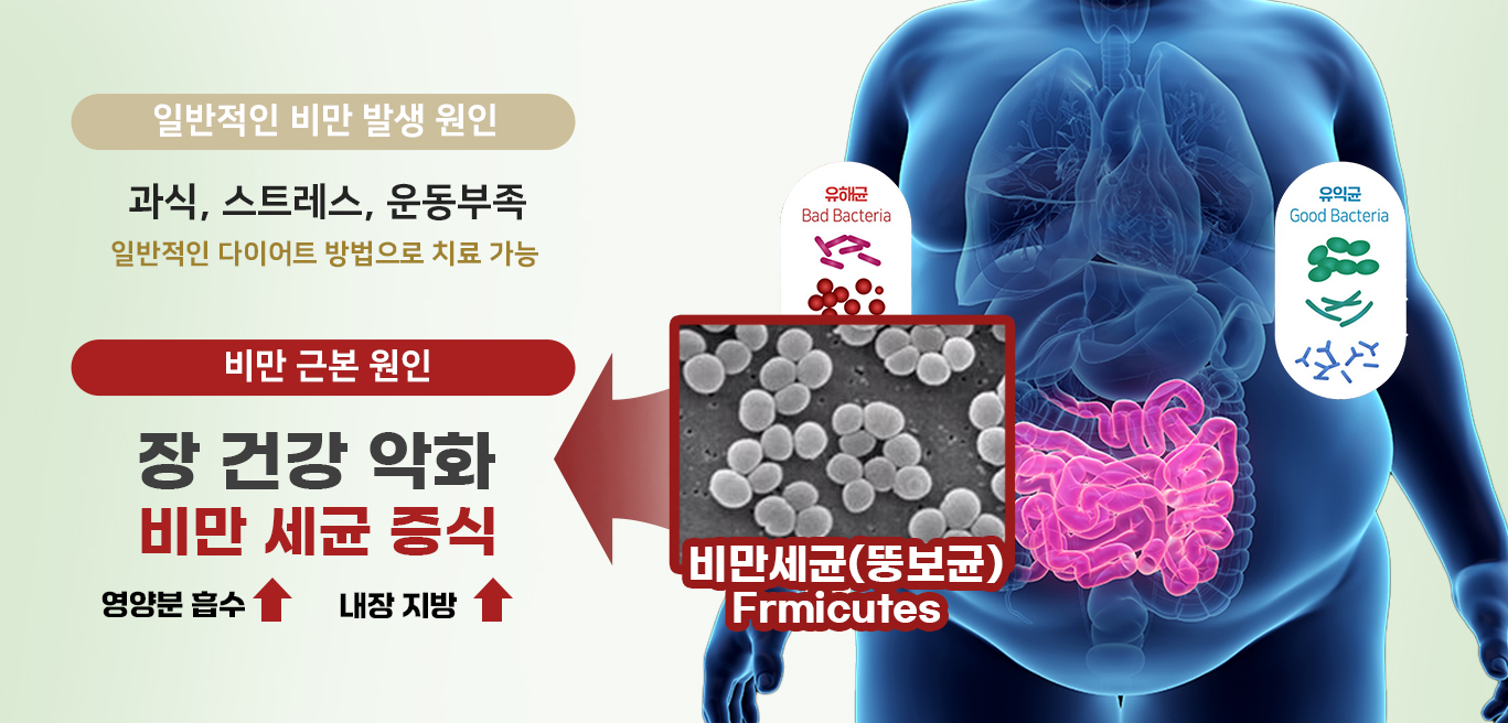 일반적인 비만 발생 원인은 과식, 스트레스, 운동부족인데 이는 일반적인 다이어트 방법으로 치료가능합니다. 하지만 비만의 근본원인이 되는 비만세균이 증식한 경우에는 장 치료를 받아야 합니다.