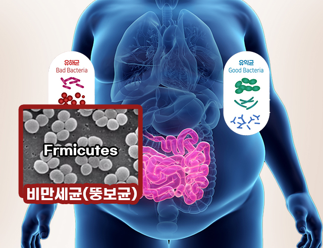 일반적인 비만 발생 원인은 과식, 스트레스, 운동부족인데 이는 일반적인 다이어트 방법으로 치료가능합니다. 하지만 비만의 근본원인이 되는 비만세균이 증식한 경우에는 장 치료를 받아야 합니다.